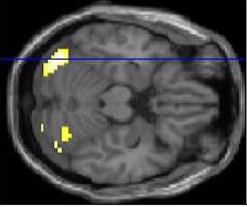 Cerebellar dysfunction during visuospatial task in CD