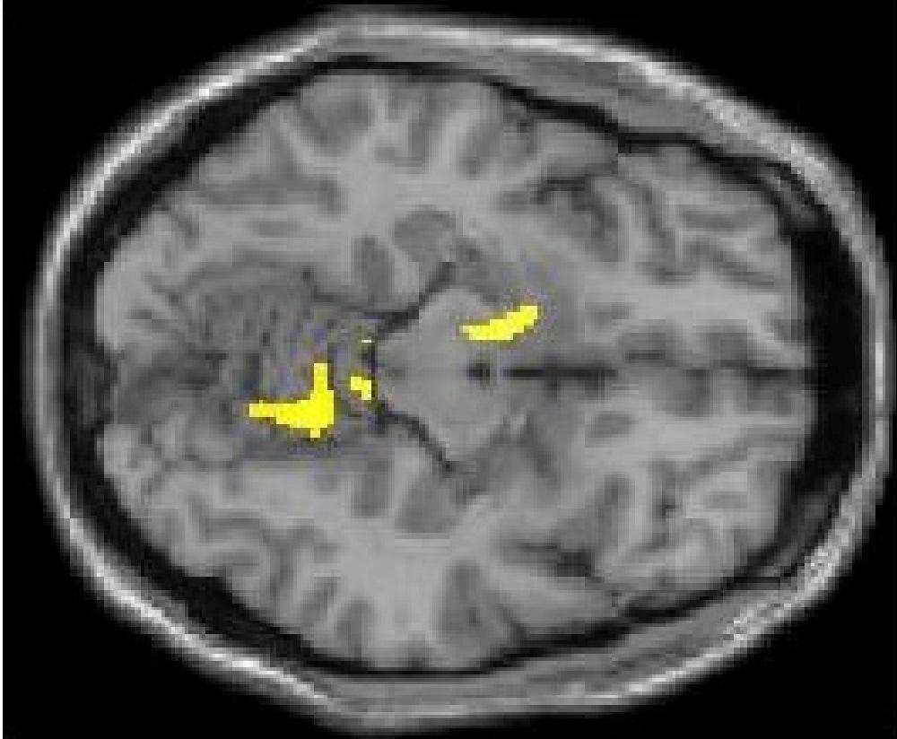visuospatial motor task Impaired cerebellar basal ganglia
