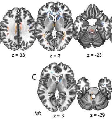 Neuroimage 2009 White matter changes in primary dystonias Diffusion Tensor Imaging (DTI) assesses water diffusion Anisotropy = directionality of water