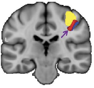 What grey matter changes are task-specific in dystonia?