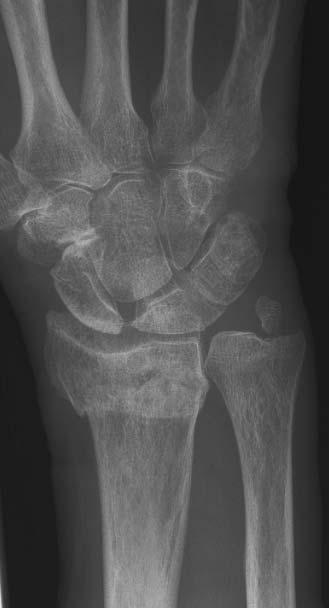 Consequences of distal radius fractures 16 The most common fracture in women at middle age Incidence increases just after menopause The most common fracture in men