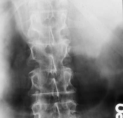 Assessing bone density 30 X-ray observation Osteopaenic on x-ray