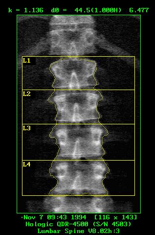 of osteoporosis BMD (g/cm 2 ) = Bone