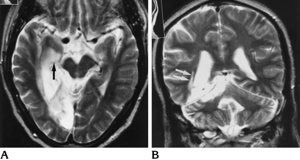 hyperintense layer. Fig 3. T2-weighted MR images from a 50-year-old man with hemiplegia and hemianopsia due to cerebral infarction.
