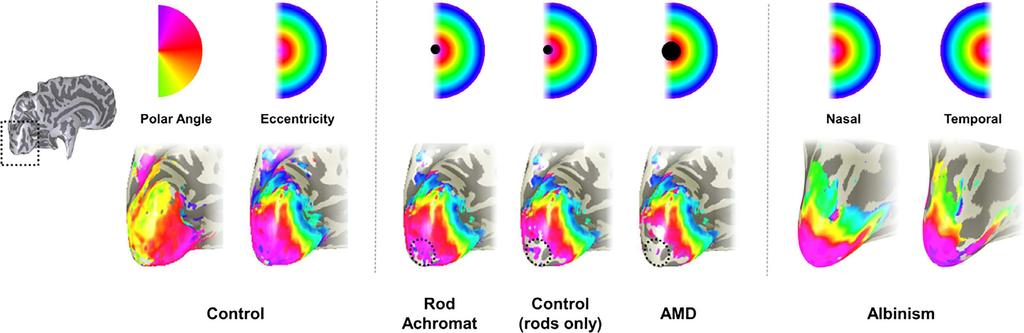 H D H Brown et al. Using MRI in visual deficit: a review factor. 121 Giving participants a simple fixation task will improve attention and in turn improve fixation stability.