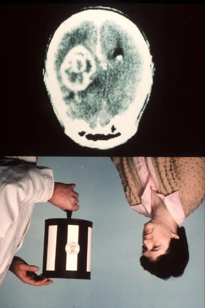CT scan of parietal lobe tumour