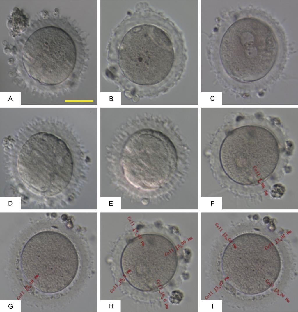Figure 1. (A and B) Oocytes with morphological abnormalities. (C) A fertilized egg with an abnormal ZP. (D and E) An embryonic abnormal ZP after 48 hours (D) and 72 hours (E).