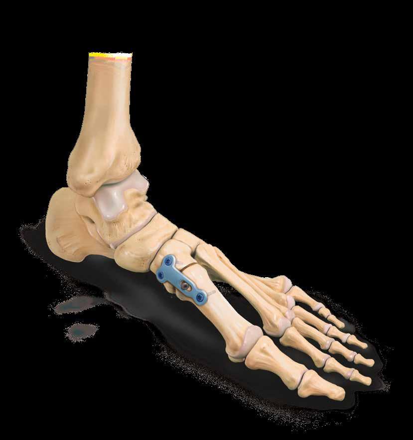 Lapidus Plate Designed to provide excellent fixation for a lapidus procedure, the Lapidus Plate offers the foot & ankle surgeon an anatomically contoured and configured option for procedures in the