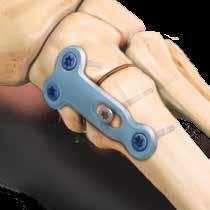 Locking Option The two proximal and most distal holes allow the surgeon to choose a fixed-angle locking or variable-angle nonlocking option, depending on the needs of the patient Compression Option