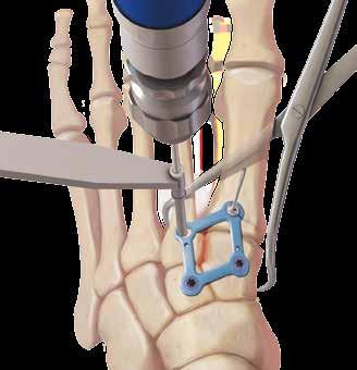 dorsally over the Lisfranc joint.