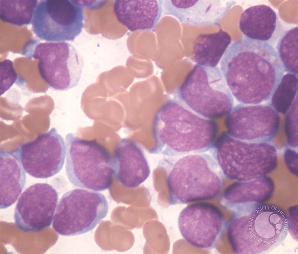 Acute Myeloid Leukemia Proliferation of myeloblasts in the bone marrow May have systemic manifestations (constitutional symptoms, skin findings,