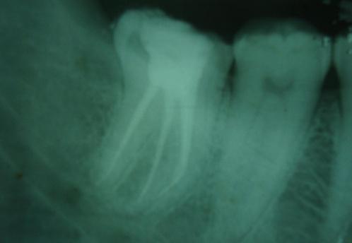 lower back tooth region for ten days. Medical history was noncontributory. Clinical evaluation revealed gross decay in mandibular right first permanent molar #46.