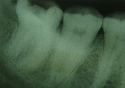 Tooth was tender on palpation and percussion. Intraoral periapical radiograph revealed a deep carious lesion progressing towards pulp chamber.