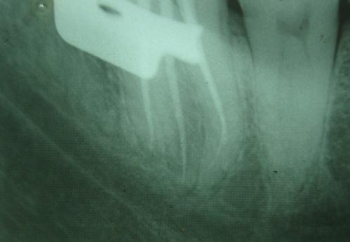 Based on the clinical and radiographic findings, diagnosis of pulpal necrosis with chronic periapical periodontitis was made.