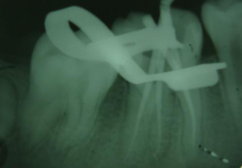 Hora et al Radix Entomolaris (Dentsply Malliefer). The mesiobuccal, mesiolingual root canals and RE were prepared with K3 system.