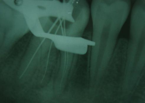 An interappointment calcium hydroxide and iodoform dressing (Calciplus) was placed in the canals and temporized.