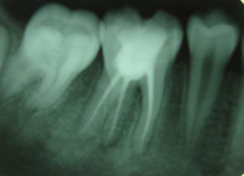 The canals were then dried with absorbent paper points. Obturation was performed with corresponding gutta percha points (Dentsply Malliefer and K3 Sybron Endo) and AH plus sealer (Dentsply Malliefer).