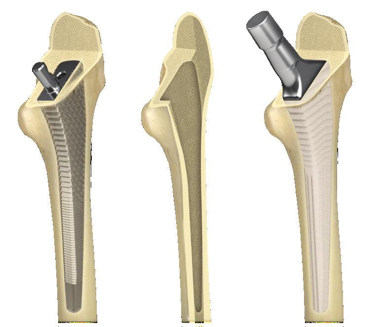 Accurate line-to-line sizing between rasp and implant allows reproducible surgery and helps
