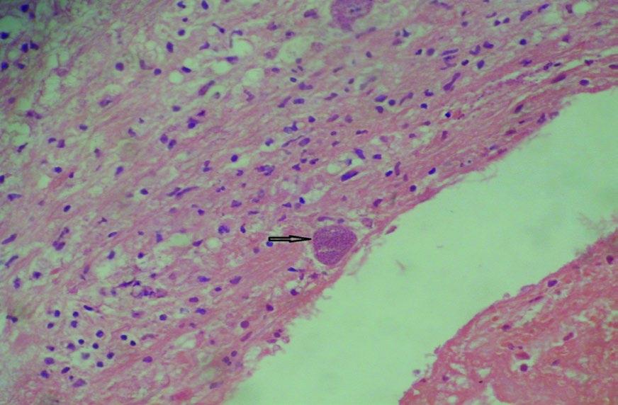 Figure 3 Bradyzoites encased in cysts with a thin wall (Black Arrow) with many lymphoid cells seen in the background. Low power view (100X).