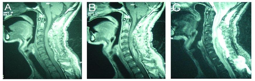 Follow-up consisted of a spinal cord and brain MRI (with and without Gadolinium) on December 2005 (1 month postoperatively), February 2006 (3 months postoperatively), July 2006 (8 months