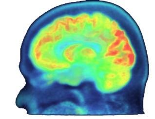 Cerebral Perfusion & Metabolism Key Findings: Resting rcbf was significantly lower in schizophrenia compared to normal controls Rostral Prefrontal cortex, Left temporal lobe, Posterior Cingulate and