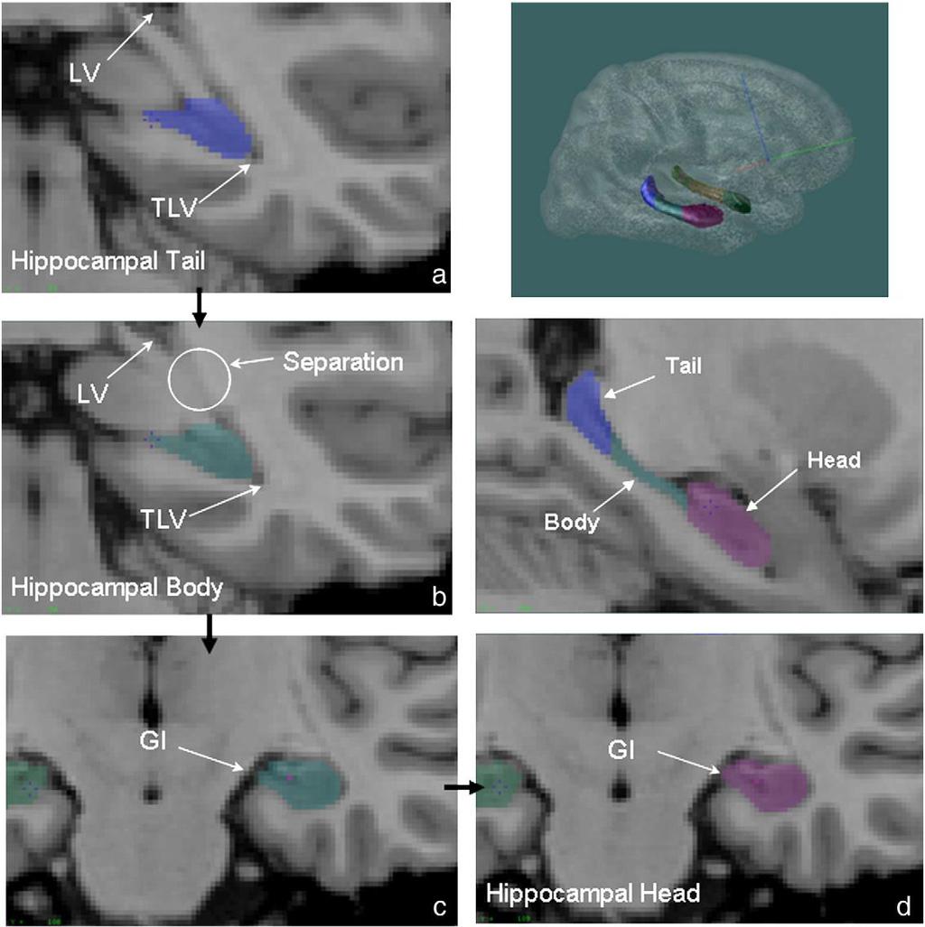 Hippocampal Formation in FES L hippocampal tail is smaller in FES non remitters compared to FES remitters and CNT R