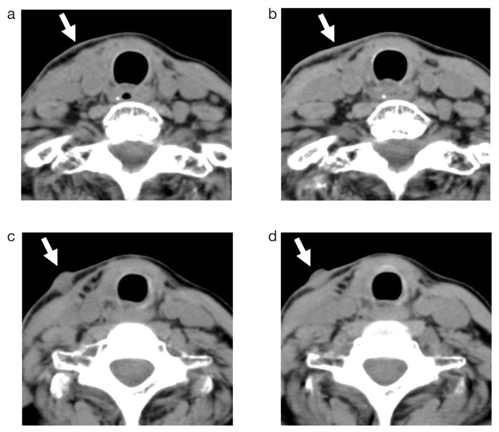 842 Ito et al. Case 3 An 82-year-old woman presented with a 5.8-cm neck mass in the right lobe of her thyroid. She had lymph node metastasis measuring 1.