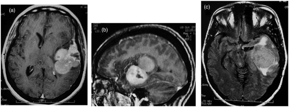 2 Acta Radiologica Short Reports 3(4) Fig. 1. MRI: left parieto-temporal dural-based infiltrating tumor. The mass had an heterogenous enhancement (a, b) with necrosis, and marked edema (c). Fig. 2.