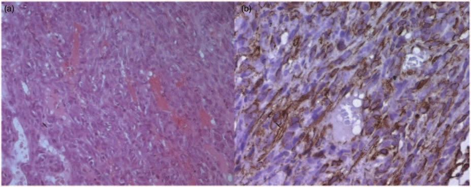 Tumor cells display strong immunoreactivity for CD 99 (b). A percutaneous transpedicular biopsy was performed and the histological findings were identical to those found in 2007 (Fig. 5a and b).