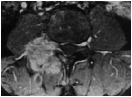 months later due to pulmonary embolism. Fig. 3. Spinal MRI: circumscribed mass within the right transverse process of the third thoracic vertebra (T3) with paravertebral extension to the soft tissues.