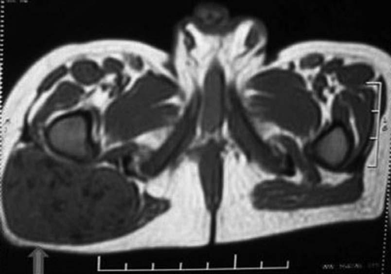 Giant calcifying aponeurotic fibroma 261 Annals of Tropical Paediatrics atp0314.3d 21/7/10 21:58:48 FIG. 3. concerning the case might be submitted for publication.
