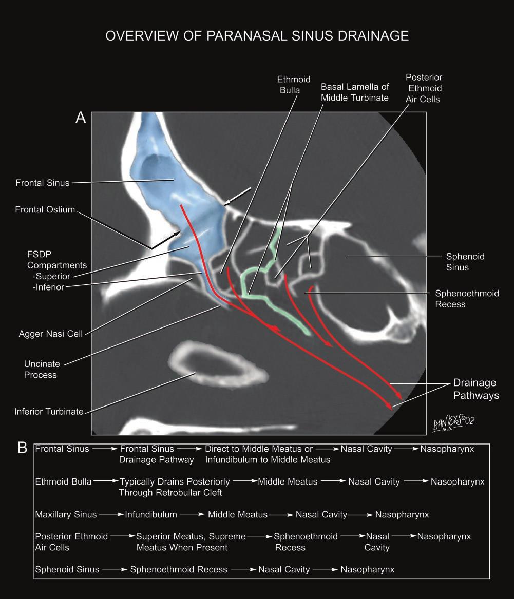AJNR: 24, August 2003 FRONTAL SINUS DRAINAGE PATHWAY 1619 FIG 1. Overview of the drainage pathways of the paranasal sinuses.