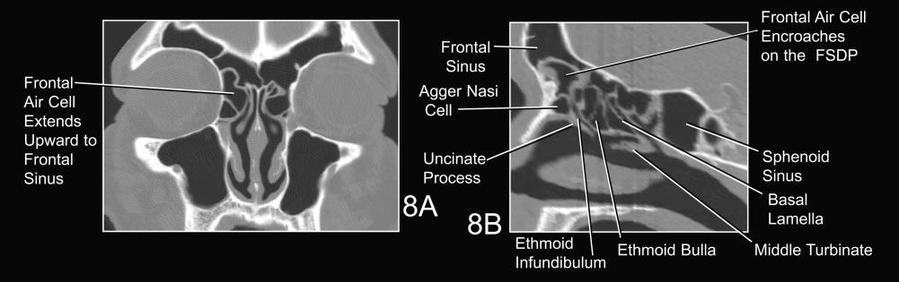 1626 DANIELS AJNR: 24, August 2003 Prominent anterior air cell encroaches on the frontal sinus and the FSDP. A, Coronal CT. B, Reformatted sagittal CT. FIG 8. FIG 9.