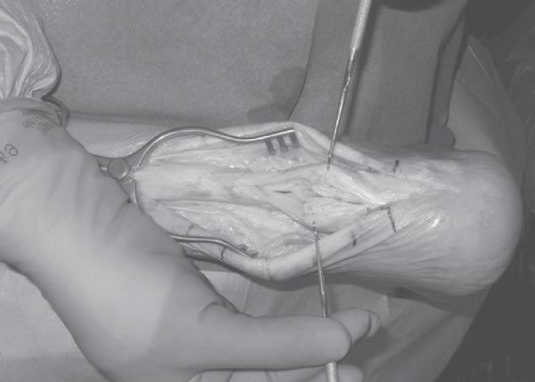 Close the defect in the proximal tendon and gastrocnemius muscle belly with interrupted sutures. Close the tendon sheath and the deep fascia, followed by skin closure.