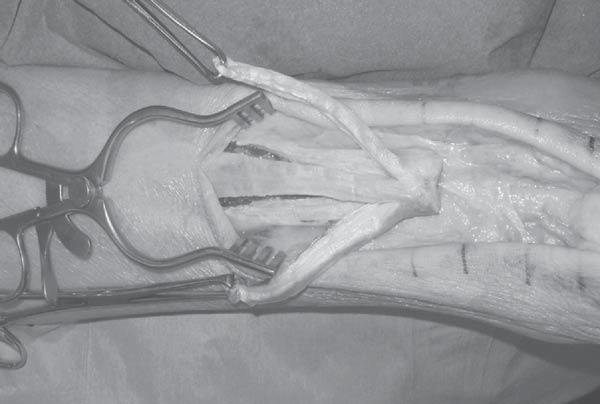 19. Fascial Turn-Down Flap Repair of Chronic Achilles Tendon Rupture 177 patient can gradually resume walking with partial weight bearing on crutches during a two-week period.