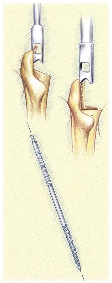 Box Chisel and Starter Awl The Box Chisel may be used to open the proximal femur prior to use of the Starter Awl or in conjunction with the Starter Awl.