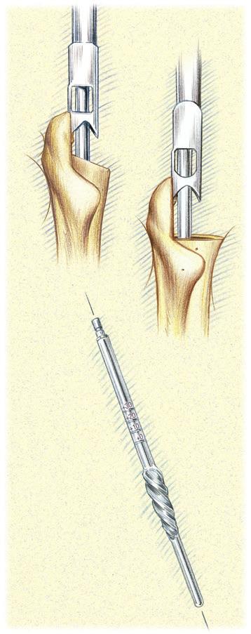 Box Chisel and Starter Awl (continued) Box Chisel Use With the Starter Awl After the awl has been used to open the femoral canal, the T-Handle or Power Reamer is removed with the awl engaged in the