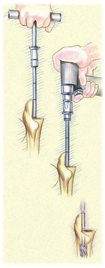 Distal Reaming Use of the Conical Distal Reamer 155mm, 195mm, 235mm Stems Conical distal reaming for the 155mm, 195mm, or 235mm Conical Distal Stems can be accomplished by use of a T-Handle (Figure