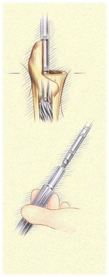 Distal Reaming (continued)/implant Insertion Use of the Conical Distal Reamer 155mm, 195mm, 235mm Stems (continued) Progressively ream until resistance accompanied by cortical chatter is encountered.