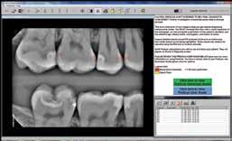 the manufacturer. How caries is detected: Program analyzes the shades of gray in a radiograph to detect density changes that represent demineralization of the tooth material.