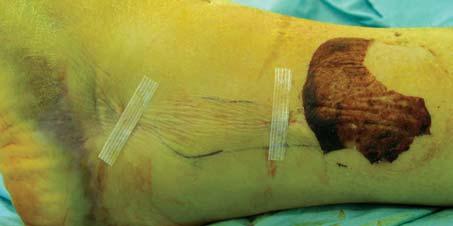 Smaller incisions can be especially beneficial for diabetic patients and those with wound healing problems.
