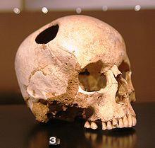 skull, exposing the dura mater in order to