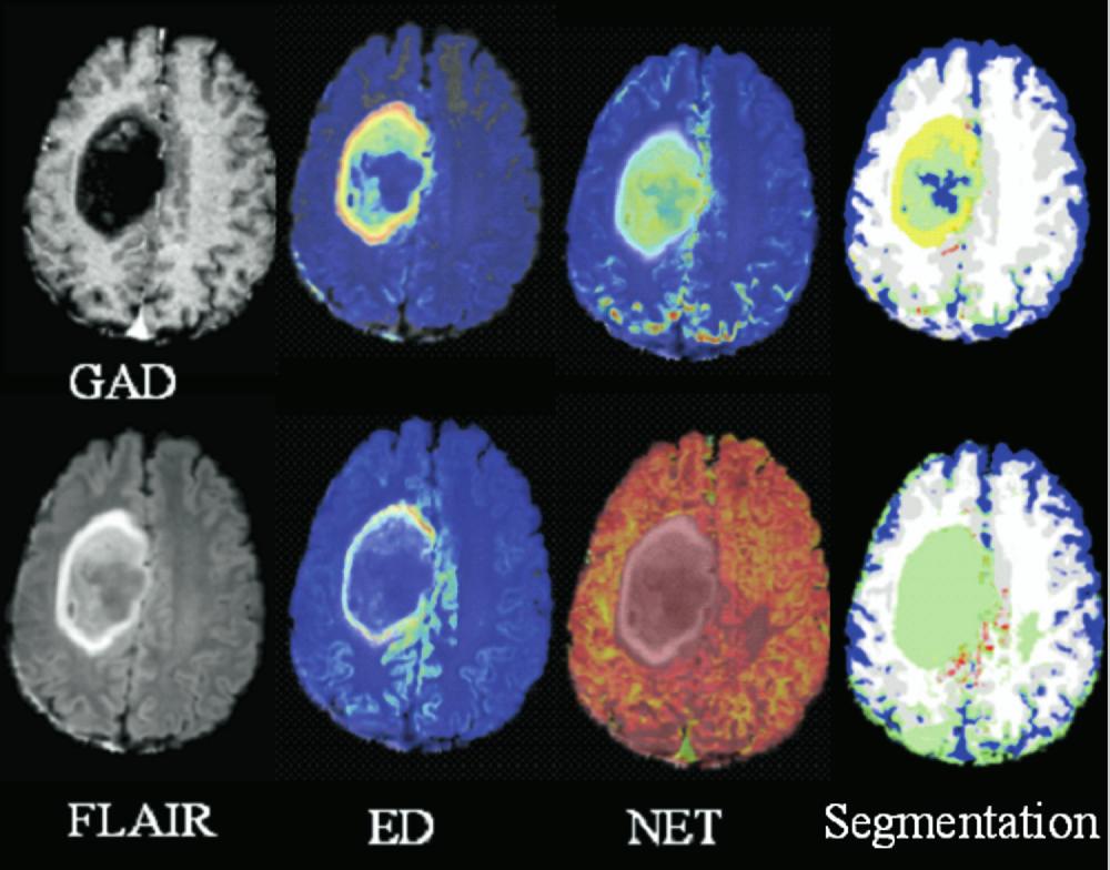 Academic Radiology, Vol 15, No 8, August 2008 TISSUE CHARACTERIZATION OF BRAIN NEOPLASMS Figure 4.