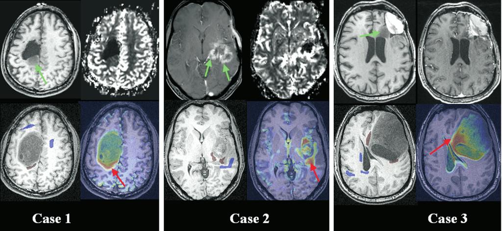Academic Radiology, Vol 15, No 8, August 2008 TISSUE CHARACTERIZATION OF BRAIN NEOPLASMS Figure 3. Maps of tumor recurrence for three cases.