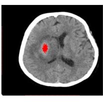 , 2011, A Fuzzy Multilayer Perceptron Network based detection and classification of lobar intra-cerebral hemorrhage from Computed Tomography images of brain, International