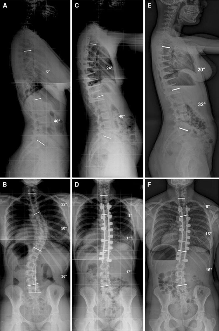 Eur Spine J (2011) 20:1149 1156 1153 Fig. 2 A 13.5-year-old girl with hypokyphotic Lenke 1C type AIS. a, b Preoperative standing sagittal and anteroposterior radiographs.