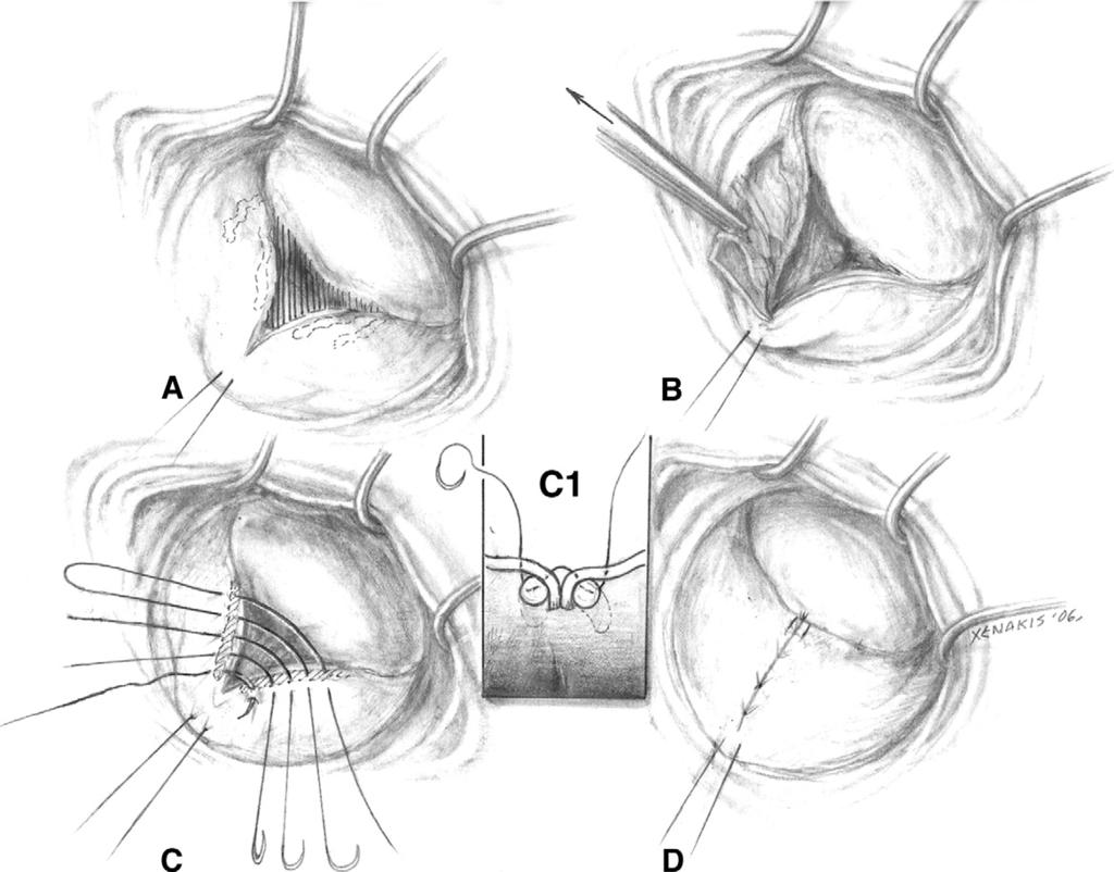70 R.A. Hopkins Figure 3 (A) The resection is relatively conservative and does not extend completely to the annulus. (B) An initial suture starts the in-folding toward the base.