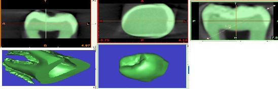 3. Modeling of Molar Crown Fig.1: Different views of tooth in MIMICS software. The natural tooth is initially constructed as a solid model with single material in ANSYS Multiphysics Environment.