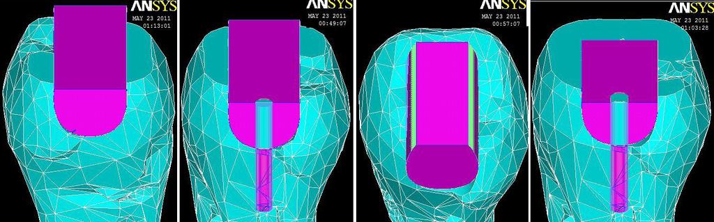 (a) (b) (c) Fig. 2: Different designs of molar Crown (d) To decide which option amongst the four designs is best, stress analysis is carried out. All the four designs are discretized and loaded.
