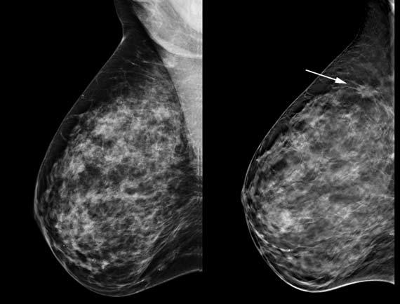 Clearly, mammographically dense breast tissue will benefit. Who will benefit from tomosynthesis? WaldherrC., et al.